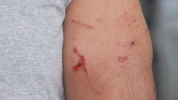 Homem sofreu ferimentos após ser atacado por cachorro em Fernandópolis (Foto: Reprodução/TV TEM)