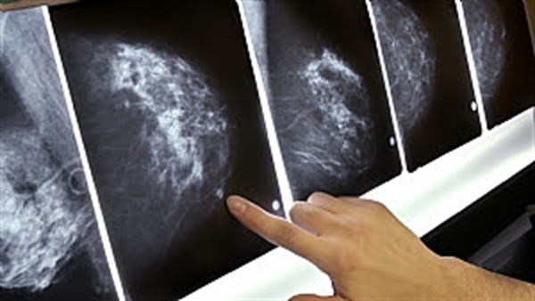 A mamografia identifica o câncer quando ainda não é palpável em um exame clínico ou através do autoexame realizado pela paciente (Foto: Divulgação)