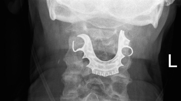 Médicos encontraram dentadura de homem em sua garganta oito dias após cirurgia no abdômen — Foto: Divulgação/BMJ Case Reports 2019
