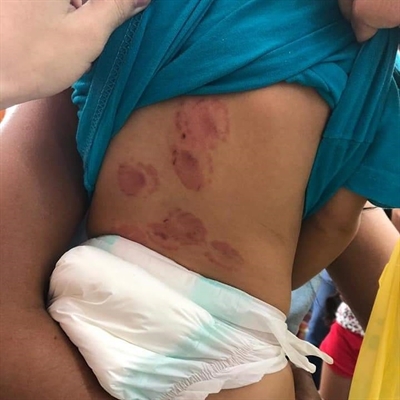 Criança sofreu mordidas nas costas em uma creche em Severínia — Foto: Arquivo Pessoal