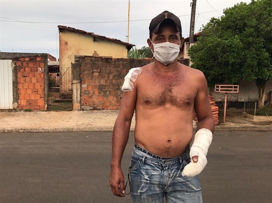 Vizinho sofreu ferimentos ao socorrer bebê durante incêndio em Araçatuba (Foto: Rafael Ferraz/TV TEM)