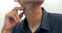 Motociclista quase é degolado por ‘linha chilena’ e leva sete pontos no pescoço em Votuporanga