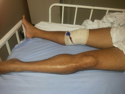 Elias Matos Junior entrou para fazer cirurgia do joelho esquerdo e acabou com a perna direita operada