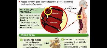 Rizotomia é usada para tratar dor lombar