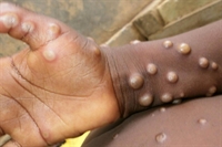  Um homem de Bady Bassitt, de 33 anos, foi o primeiro morador da região é testar positivo para a varíola dos macacos (Foto: Reprodução)